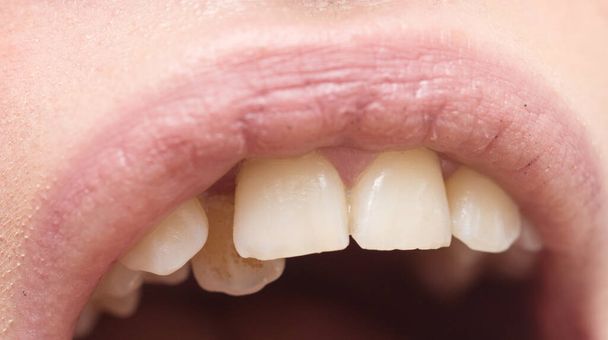 Close up shot of crooked teeth - Photo, Image