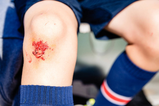 Rana krwi na kolanie dziecięcego sportowca. - Zdjęcie, obraz