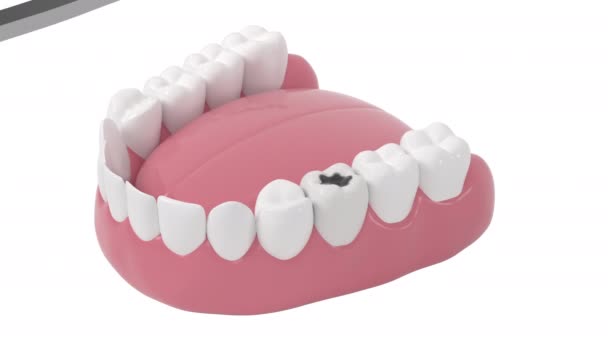 Збільшення розпаду зубів, нездорові зуби, 3d рендеринг
. - Кадри, відео
