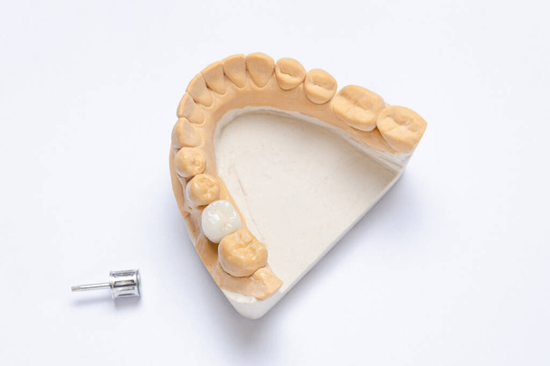 Κεραμικός γομφίος σε οδοντικό εμφύτευμα. μοντέλο γύψου κάτω γνάθου - Φωτογραφία, εικόνα
