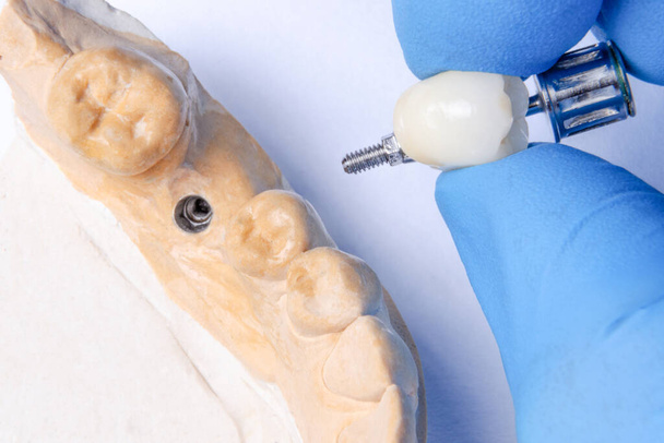 the dentist's hand holds a ceramic crown for fixation on the implant. dental model with dental implant - Photo, Image