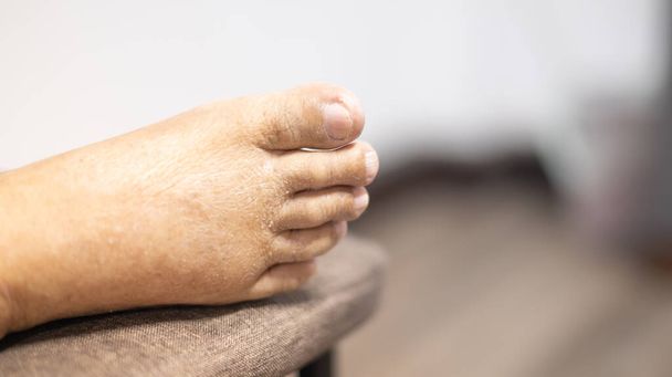De voeten van de oude man rimpel huid gezwollen voeten met de kanker en het lichaam gebrek aan het eiwit voor de gezondheid dus niet goed. - Foto, afbeelding