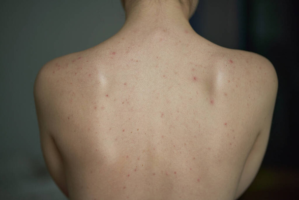 Vrouw terug met acne. Huidverzorgingsproblemen. Een jong meisje met allergie op haar huid. Dermatologisch concept - Foto, afbeelding