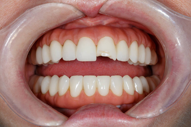 治療前の歯の歯.歯のクローズアップ写真。歯が白くなるイメージ。新しい笑顔のための治療計画。漂白剤からベニヤを作る。歯科写真. - 写真・画像
