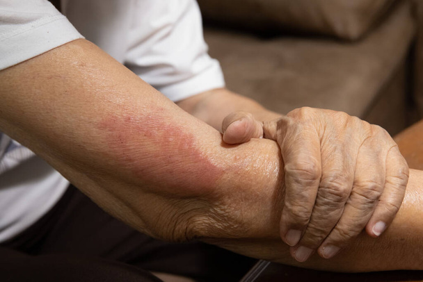 vaccin covide 19 allergies symptômes chez les personnes âgées après la vaccination. - Photo, image