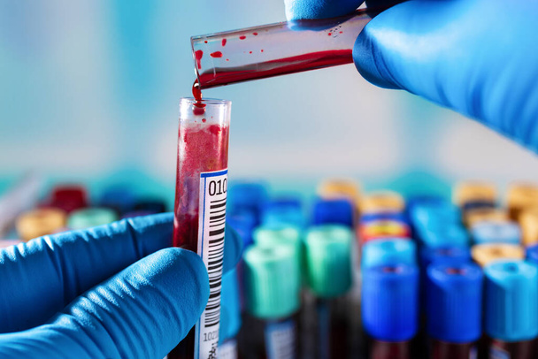 El técnico de laboratorio que mezcla la muestra de sangre en diferentes tubos puede contaminar la muestra. técnico que trabaja en laboratorio con muestras de sangre para manchar frotis y diapositivas - Foto, imagen