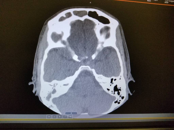Vaskulitis mit Stirnhöhlenentzündung - CT der Nasennebenhöhlen und des Gehirns - Foto, Bild