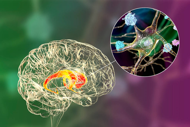 ハンティントン病における脳の根粒菌核への神経学的包含、 3Dイラスト。内包物は変異したハンチンチンタンパク質で構成されており、核、軸索、樹状突起に見られる。 - 写真・画像