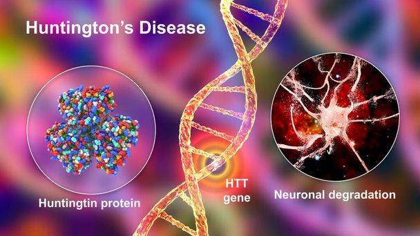 Choroba Huntingtona, znana również jako chorea Huntingtona, choroba neurodegeneracyjna spowodowana mutacją genu Huntingtin, HTT, degradacją neuronów i ruchami choreograficznymi, ilustracja 3D - Zdjęcie, obraz