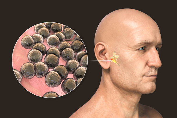 Streptococcus pneumoniae bacterium as a cause of otitis media. Illustration 3D montrant une inflammation purulente de l'oreille moyenne chez un homme et une vue rapprochée des bactéries pneumococciques - Photo, image