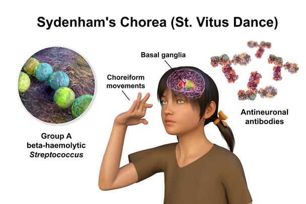 Sydenham chorea, een auto-immuunziekte die het gevolg is van Streptococcus infectie, vorming van anti-neuronale antilichamen beschadigen hersenen basale ganglia die onvrijwillige bewegingen veroorzaken, 3D illustratie - Foto, afbeelding