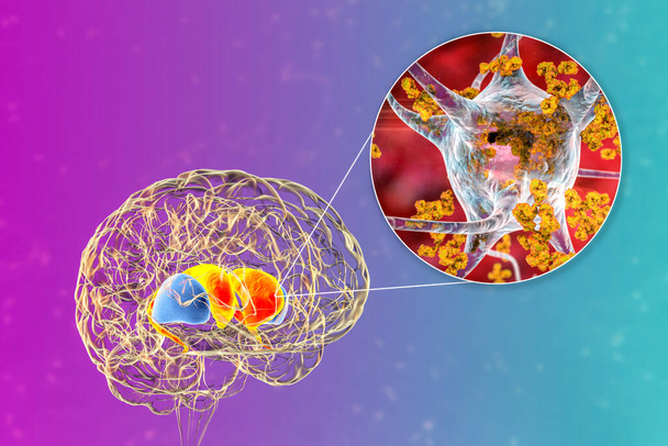 Protilátky proti neuronům, protilátky proti bazálním gangliím. 3D ilustrace ukazuje imunoglobuliny útočící na neurony v hřbetním striatu lidského mozku. Jsou nalezeny v postrevmatické horečce chorea - Fotografie, Obrázek