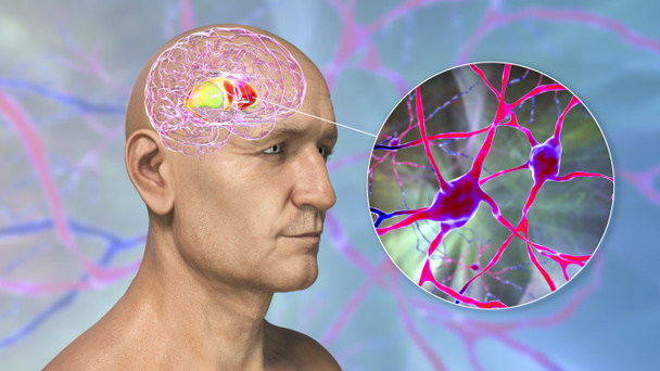 Dorsal striatum korostettu ihmisen aivoissa ja lähikuva sen neuronien, 3D-kuva. Se on ydin tyven ganglia, osa moottorin ja palkita järjestelmiä - Valokuva, kuva
