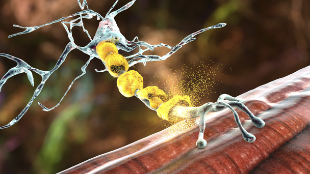 Αποχρωματισμός του νευρώνα, η βλάβη του νευρώνα θήκη μυελίνης δει σε απομυελινωτικές ασθένειες, 3D απεικόνιση. Σκλήρυνση κατά πλάκας και άλλες απομυελινωτικές μυελοκλαστικές και λευκοδυστροφικές ασθένειες - Φωτογραφία, εικόνα