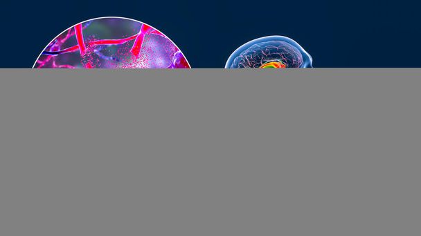Dorsal striatum, caudate nucleus en putamen, gemarkeerd in de hersenen van een persoon met de ziekte van Huntington en close-up zicht op neuronale degradatie, conceptuele 3D illustratie - Foto, afbeelding