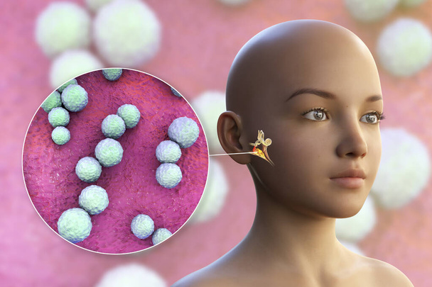 Стрептококова бактерія як причина ототиту. 3D ілюстрація, що показує гнійне запалення середнього вуха у дівчини та крупним планом бактерії стрептококів
 - Фото, зображення