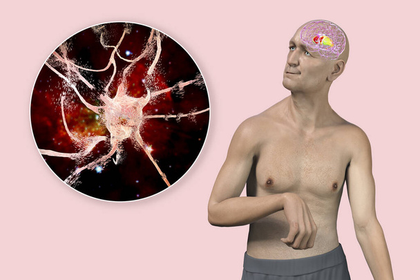 Дорсальний стріатум, каудатеве ядро та пудамен, виділені в мозку людини з хворобою хореї та крупним планом зору на нейронну деградацію, концептуальна 3D-ілюстрація
 - Фото, зображення