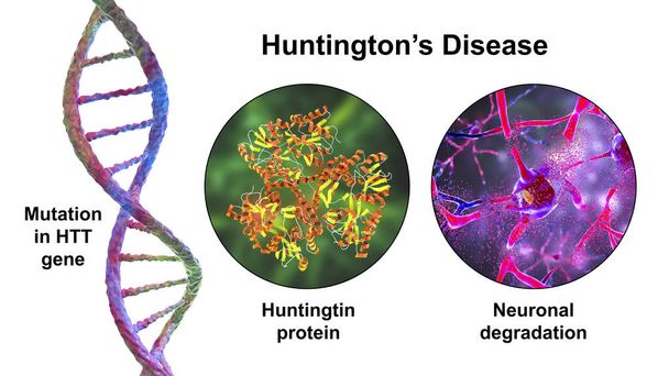 De ziekte van Huntington, ook bekend als Huntington 's chorea, een neurodegeneratieve ziekte als gevolg van een mutatie in het huntingtin gen, HTT, neuronale degradatie en choreiforme bewegingen, 3D illustratie - Foto, afbeelding