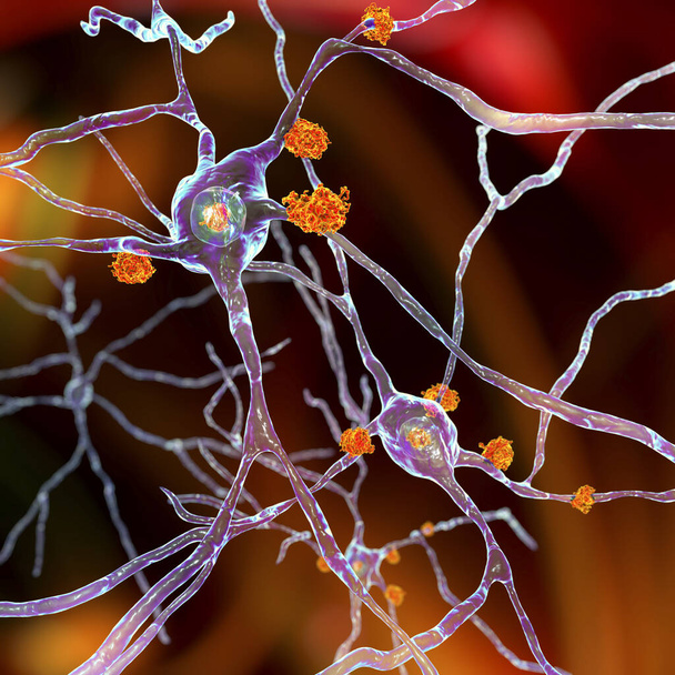 Нейронные включения в болезни Хантингтона, трехмерная иллюстрация. Включения состоят из мутировавшего белка охоттингтина, сначала формируются в аксонах и дендритах, затем мигрируют в ядра нейронов. - Фото, изображение