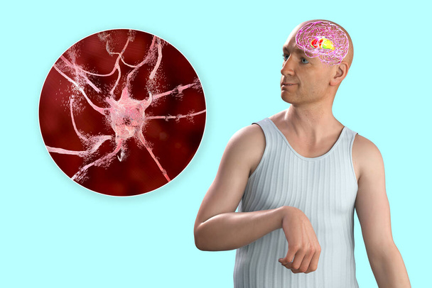 Dorsal striatum, καυτηριακός πυρήνας και putamen, τονισμένα στον εγκέφαλο ενός ατόμου με χοριακή νόσο και κοντινή οπτική της νευρικής αποικοδόμησης, εννοιολογική τρισδιάστατη απεικόνιση - Φωτογραφία, εικόνα