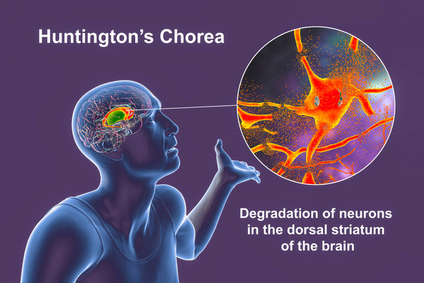 Dorsal striatum, caudate nucleus and putamen, highlighted in the brain of a person with Huntington's disease and close-up view of neuronal degradation, conceptual 3D illustration - Photo, Image
