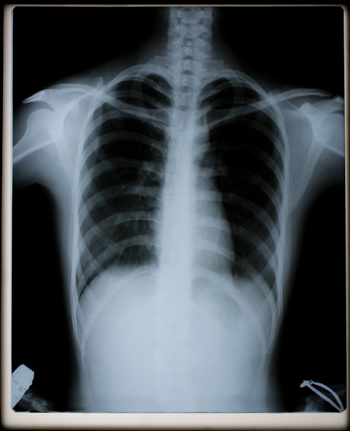 Fotos de radiografias de tórax e o sistema respiratório para diagnóstico no tratamento de doenças Imagens de radiografias tiradas da sala de radiografia para diagnóstico de falhas que exigem cirurgia para médicos - Foto, Imagem
