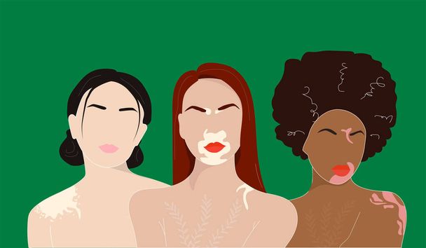 Drei Frauen mit Vitiligo verschiedener Nationalitäten stehen zusammen. Konzept zur Unterstützung von Menschen, die mit Vitiligo leben. Vektorillustration - Vektor, Bild