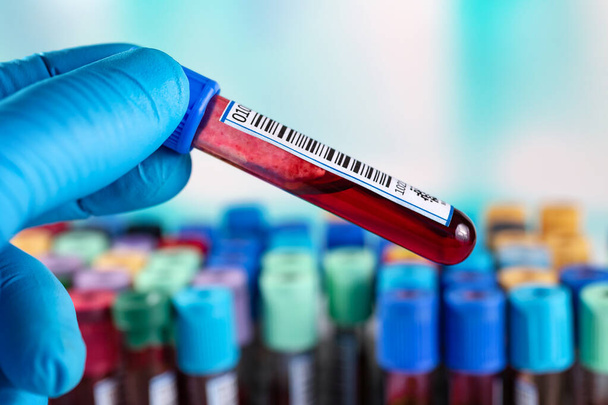 Handhalterohr in hämolysierter Blutprobe bei Gerinnung. Blutprobe für Gerinnungstest im Labor - Foto, Bild