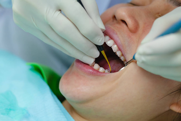 Attraktive Frau unterzieht sich einer zahnärztlichen Behandlung und Spezialist mit Gummihandschuhen macht die Untersuchung und Heilung der Zähne Patientin. Mundgesundheitliches Konzept.  - Foto, Bild
