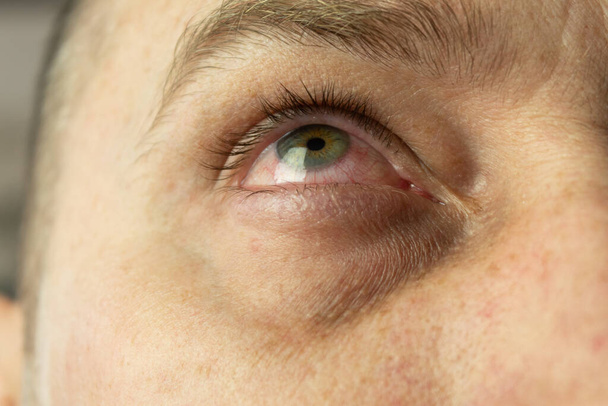 Red and inflamed eye close-up. Patient's red eye. Allergic reaction - Photo, Image