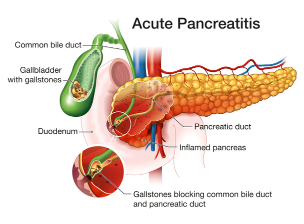 Pâncreas inflamado, cálculos biliares bloqueando ducto biliar e ducto pancreático - Foto, Imagem