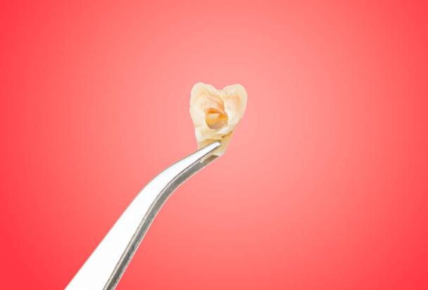 Pinsetit tilalla vanha poistettu crack viisaus hammas sydämen muotoinen suun punaisella pohjalla, hammaslääkäri löytyi epäterveellisiä vaurioituneita onteloita hampaat aiheuttavat kipua hammaslääketieteen sairaalassa - Valokuva, kuva