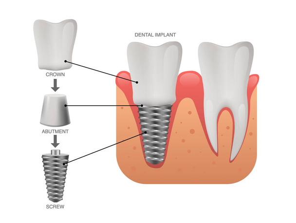 Структура зубних імплантатів, зуби людини та зубні імплантати, Векторні ілюстрації
 - Вектор, зображення