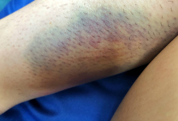 Moretón azul-púrpura de cerca en la pierna. - Foto, imagen