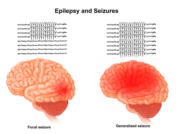Medical illustration of Focal Seizures  - Photo, Image
