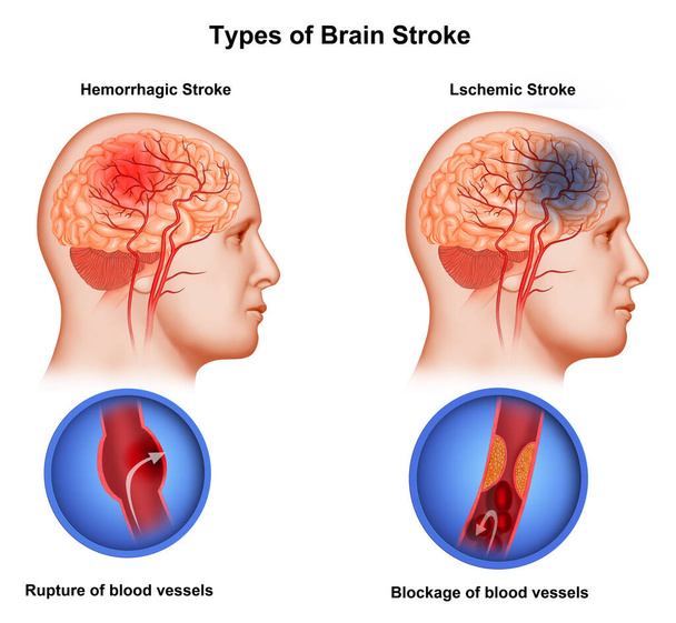 Medical illustration  Two Types of Brain Stroke - Photo, Image