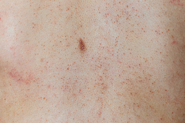 Проблема жіночої шкіри пори і темні плями на обличчі
 - Фото, зображення