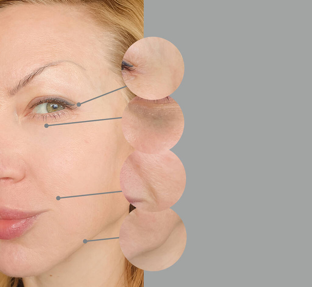 arrugas de la cara de la mujer antes y después del tratamiento collage - Foto, imagen