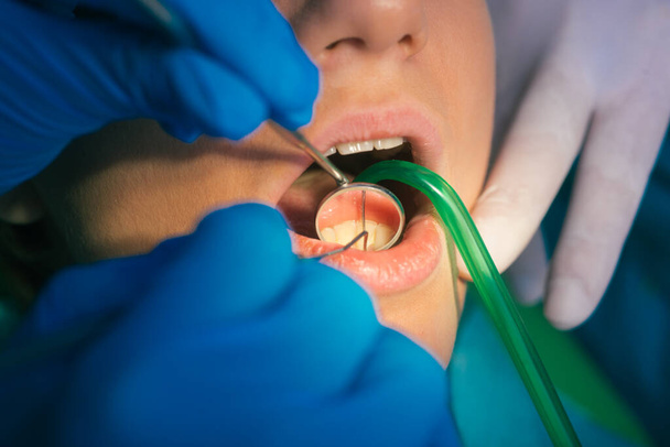 Closeup exame dental limpo sobre os dentes de uma mulher em um consultório odontológico - Foto, Imagem