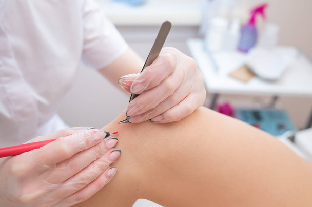Close-up of electro epilation on the leg. The doctor removes unwanted hair from the patient with an electric device and tweezers - 写真・画像