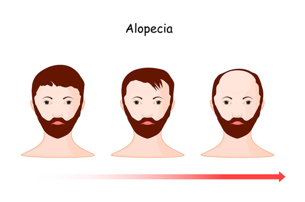 Alopezie. Haarausfall. Haarausfall aus einem Teil des Kopfes eines Mannes im Laufe der Zeit. Vektorillustration Kopf und Zeitlinie des Menschen - Vektor, Bild