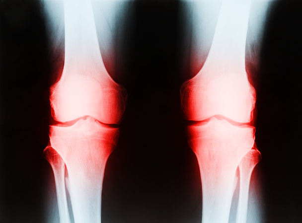 x-ray starszy mężczyzna prawego i lewego kolana Tibii i kłamstwo - Zdjęcie, obraz