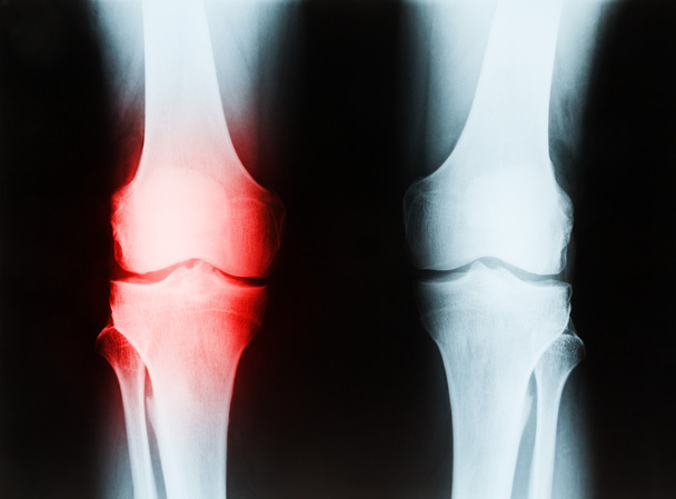 シニア男性右と左の膝脛骨と fib を示すの x 線 - 写真・画像