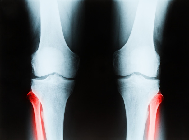 Radiografía de una rodilla derecha e izquierda masculina mayor que muestra tibia y fibrilación
 - Foto, imagen