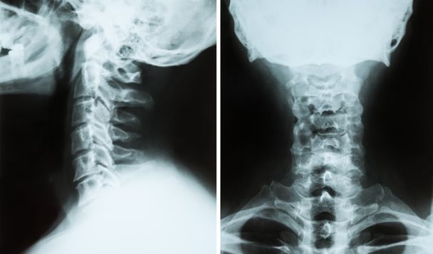 2 つの x 線画像、銭の頚椎 spine(neck) の合成 - 写真・画像