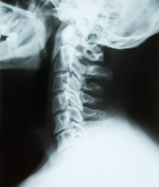 ビューの f、シニア男性患者の頚椎 spine(neck) の x 線 - 写真・画像