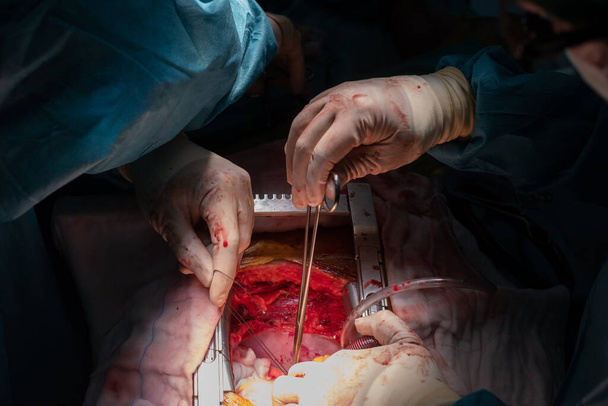 coronaire bypass graft operation (CABG). Chirurgie voor Coronaire Bypass Grafting: CABG. De arts en het personeel behandelen met een open hart cardiale bypass chirurgie in de volledige operatiekamer. - Foto, afbeelding