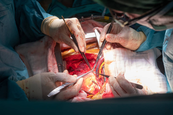 sepelvaltimon ohitusleikkaus (CABG). Leikkaus sepelvaltimon ohitusleikkaus: CABG. Lääkäri ja henkilökunta hoitavat sydämen avosydänleikkausta täydessä leikkaussalissa.. - Valokuva, kuva