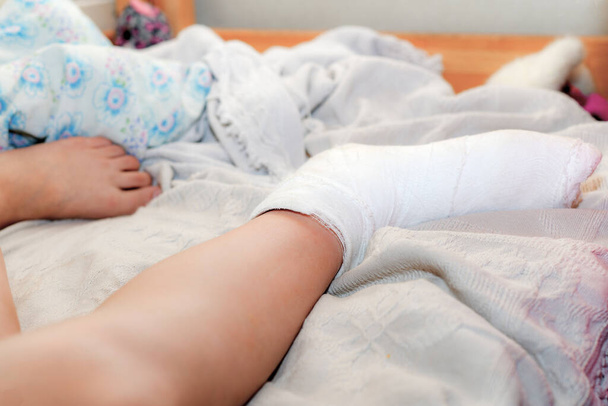 The girl is resting on the bed after a broken leg. Bandaged human leg. - Photo, Image