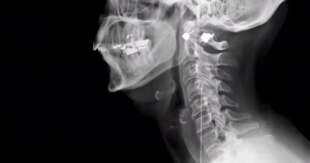 Röntgenkuva ihmisen kaulasta ja päästä, kallistus - Materiaali, video